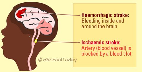 Causes of stroke