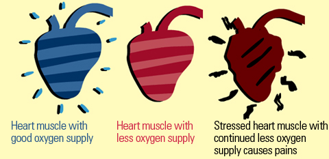 Angina is caused by blocked blood vessels