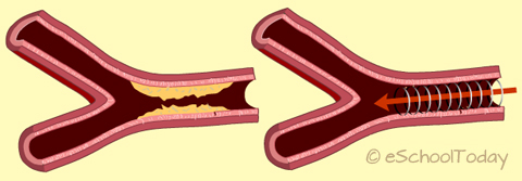 treating heart disease