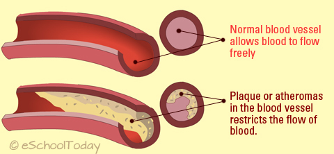 Atherosclerosis - What Is Atherosclerosis?