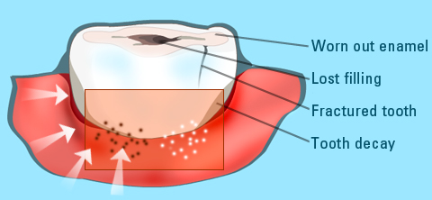 Sensitive tooth