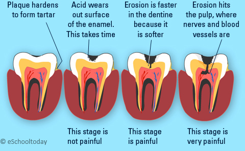 stages of tooth decay